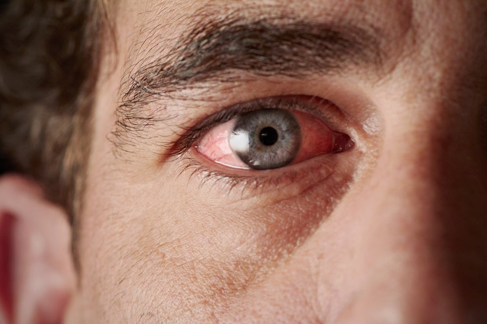 Middle-aged man with bloodshot eyes caused by an allergy to cannabis.